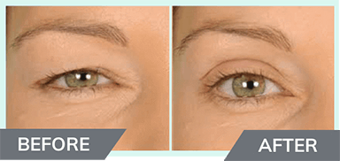 Contours Rx Eyelid Correcting Strips for Hooded Eyes